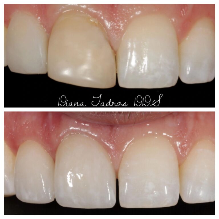 dental crown before and after photos fort lauderdale case 1
