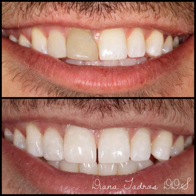 dental veneers before and after photos north corals case 9