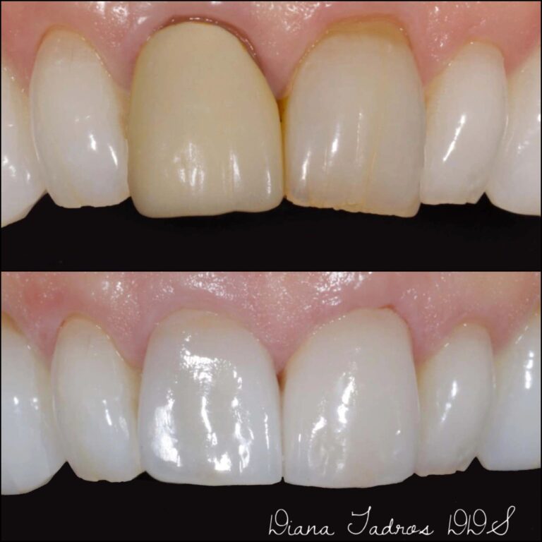 dental veneers before and after photos lauderdale by the sea case 12