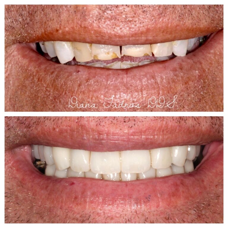 dental veneers before and after photos fort lauderdale case 1