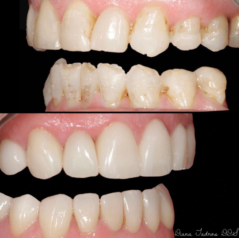 dental veneers before and after photos lake estates case 10