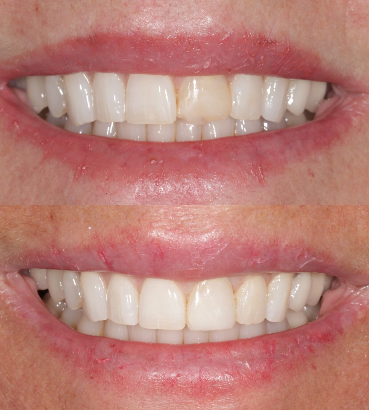 Cosmetic Dental Bonding Fort Lauderdale Pompano Beach FL